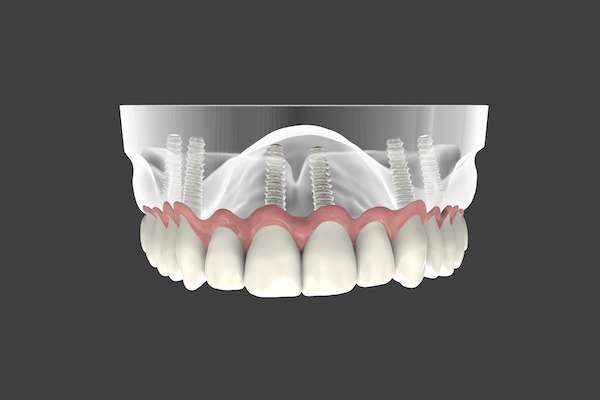 Are Implant Supported Dentures Permanent from Aesthetic Smile Center of Pompton Plains in Pequannock Township, NJ