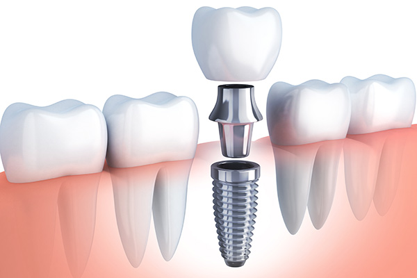Questions to Ask Your Implant Dentist from Aesthetic Smile Center of Pompton Plains in Pequannock Township, NJ